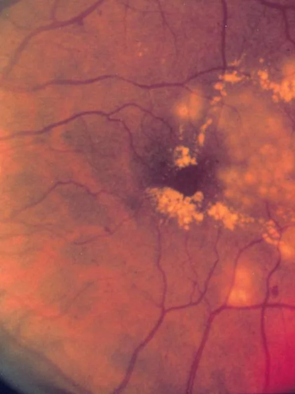 Medical Laser Eye Surgery